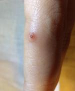 Средство для удаления бородавок Диас Супер Чистотел фото