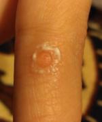 Средство для удаления бородавок Диас Супер Чистотел фото