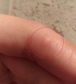 Средство для удаления бородавок Диас Супер Чистотел фото