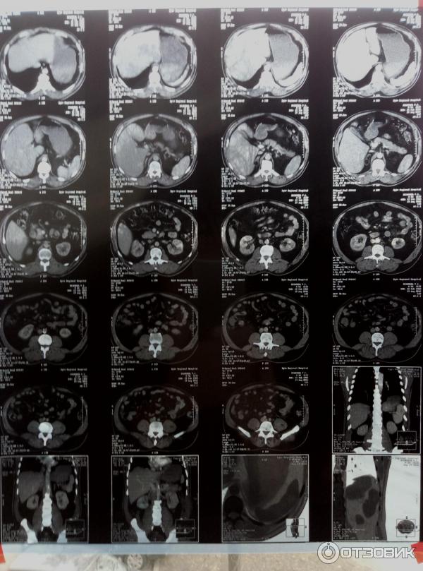 Стоимость Кт Брюшной Полости