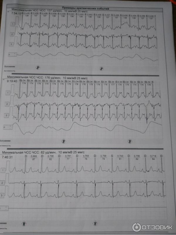 Примеры экг с ответами. ЭКГ примеры. Суточный мониторинг ЭКГ. Схема суточного мониторинга ЭКГ. Журнал учета ЭКГ.
