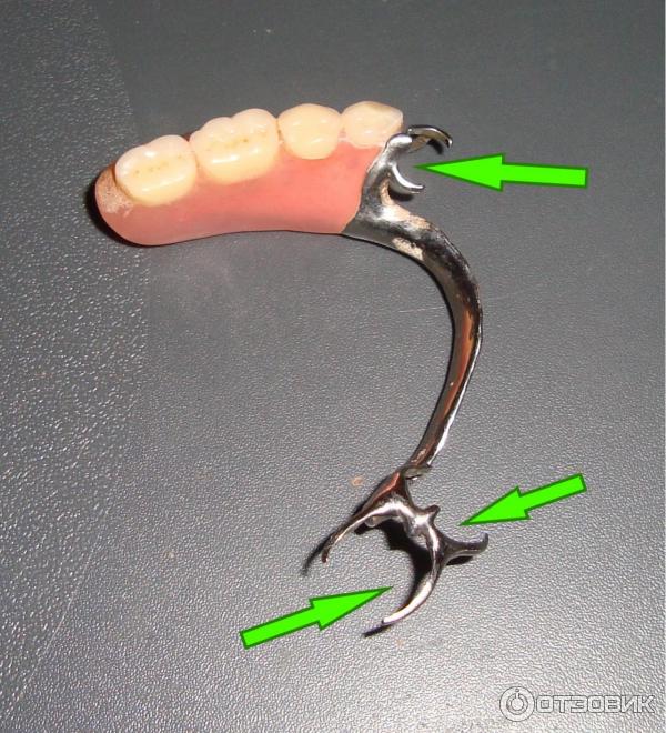 Дробители нагрузки бюгельного протеза. Нижний бюгельный протез на кламмерах. Бюгельный протез 1эзуб. Бюгельный протез кламмера. Бюгельный протез с балочной системой фиксации.