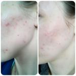 Крем от веснушек и пигментных пятен РеалКосметикс "Клирвин" фото