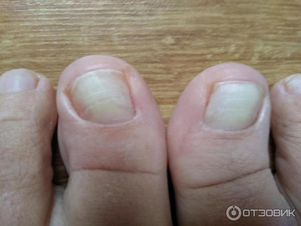 Лечение скрученного ногтя: причины – что делать, если скручивается ноготь на большом пальце ноги
