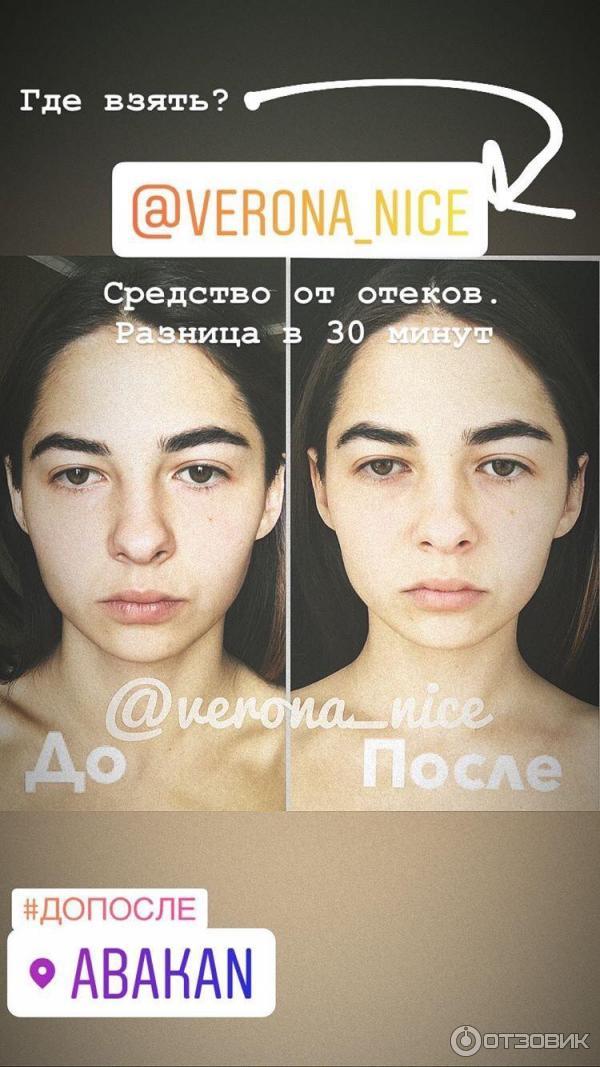 Nl Отзывы Фото До И После