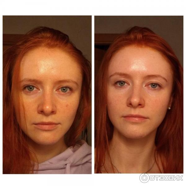 М22 фотоомоложение до и после отзывы Отзыв о Фотоомоложение фотоомоложение на лазере IRRADIA COMPACT. какие надежды о